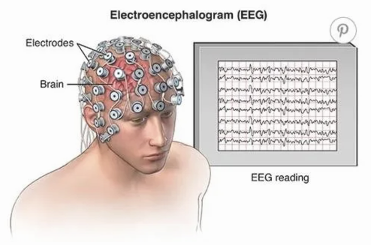 腦波圖 EEG