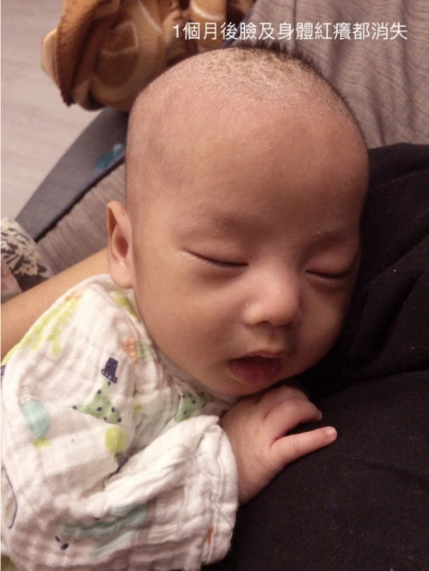 1個月後臉及身體紅癢都消失，寶寶喝奶順很多，睡覺時有比較不會一直撓臉了~