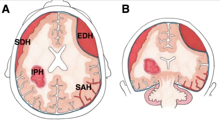 顱內出血類型（A）軸向視圖和（B）冠狀視圖；EDH = 硬腦膜外血腫、SDH = 硬腦膜下血腫、SAH = 蜘蛛膜下腔出血、IPH = 實質內出血 (來源：TeachMe)