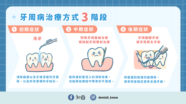 牙周病治療方式3階段