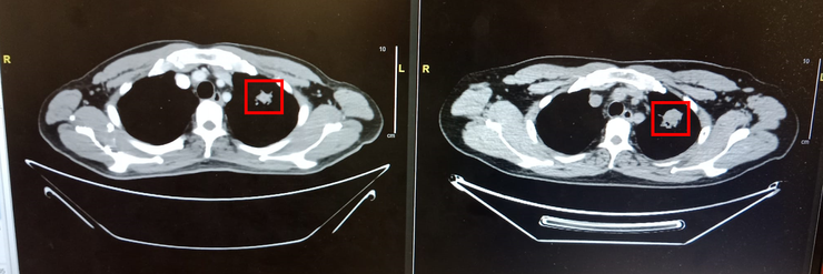 左邊是2月，右邊是去年拍的，可以見到紅框中的百點（癌細胞）小了約一半