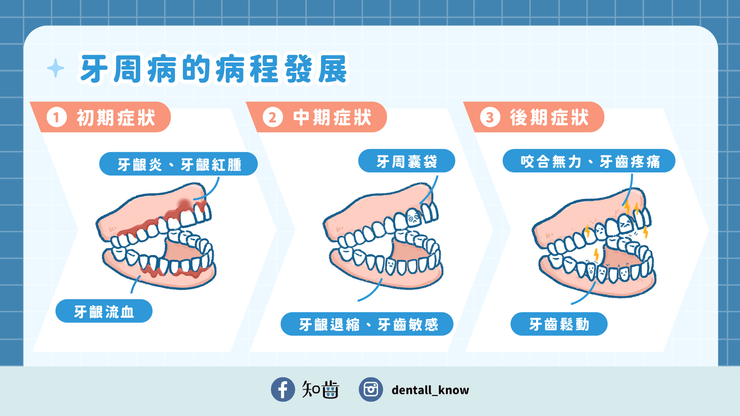 牙周病的病程發展