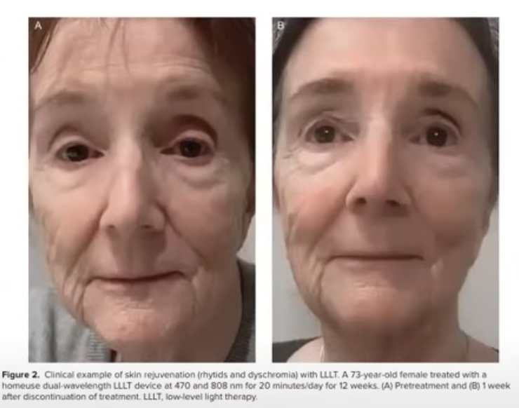 73歲女性接受低能量光療每天20分鐘持續12週後的皮膚再生