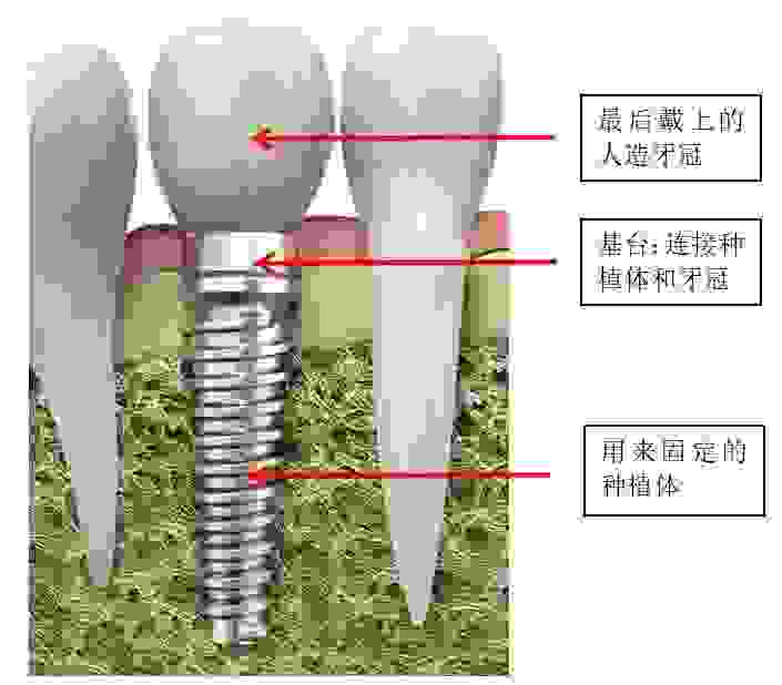 種植牙有3個部分構成-善貝口腔-深圳種植牙醫院