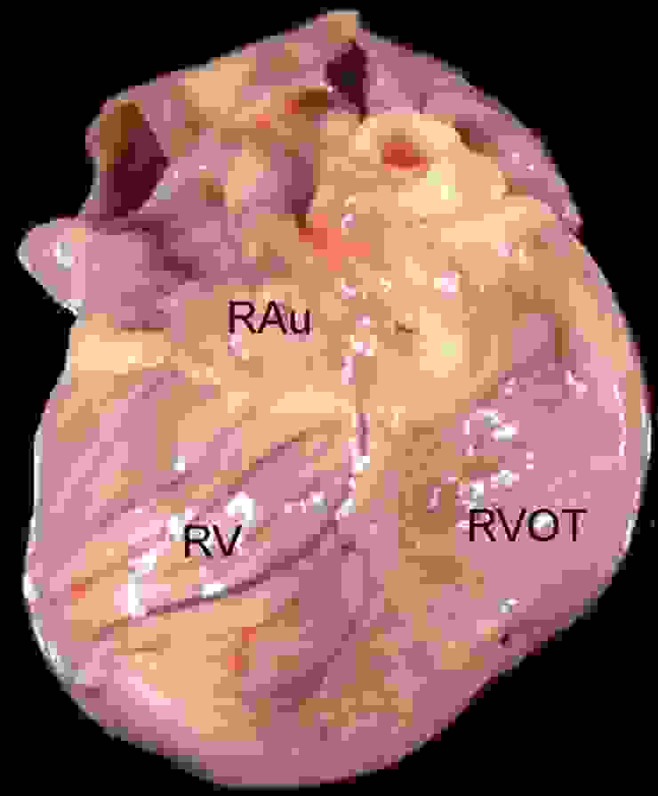 致心律失常性心肌病（ARVC)右心變大變薄