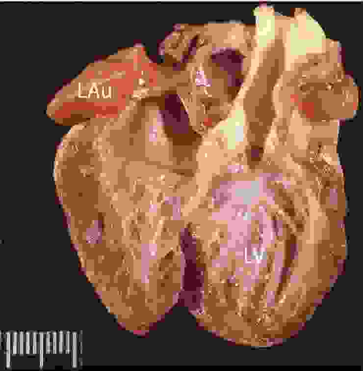 限制性心肌病，左心室心內膜變厚與纖維化變白，左心耳擴張
