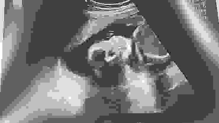 24週胎兒超音波影響/Ching拍攝