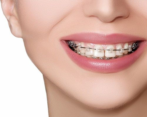 牙齒齙牙矯正需要拔牙嗎