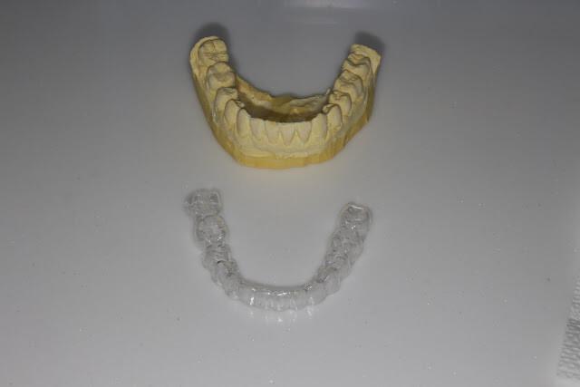 
透明維持器（clear overlay）與石膏模型分離，跟隱形牙套很像吧，兩者工序很像，只是材質不同
