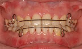 Hewley's retainer
哈雷維持器(口內照)
