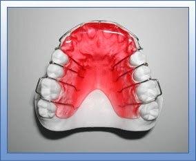 Hewley's retainer
哈雷維持器在石膏模型上