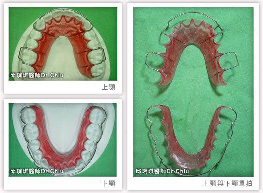 上顎維持器是Hewley's retainer,下顎維持器是wrap around retainer(詳細介紹在文末FAQ 2)
此為邱醫師的個人習慣,通常上下形式都一樣 ,