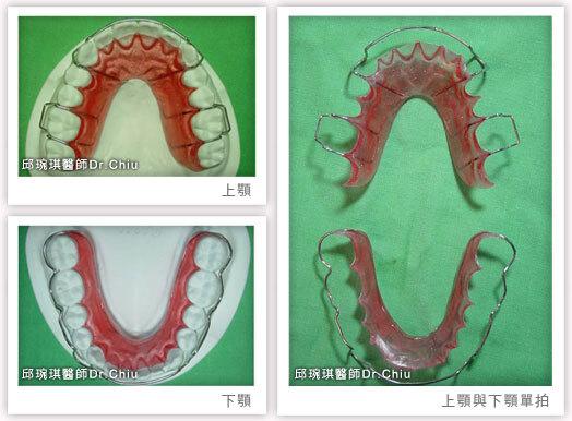 上顎維持器是Hewley's retainer，下顎維持器是wrap around retainer（詳細介紹在文末FAQ 2）
此為邱醫師的個人習慣，通常上下形式都一樣 ，
