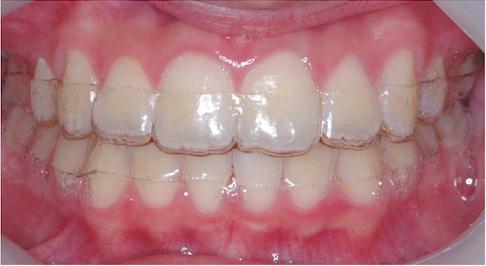 透明維持器(clear oerlay)口內照,跟隱形牙套很像吧