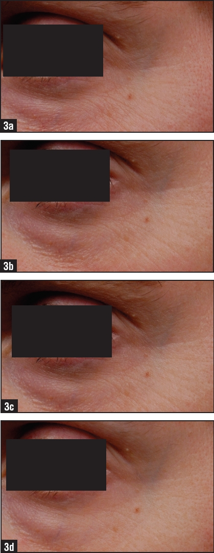 結論:該研究的結果表明,這種獨特配方的紋路線條治療具有良好的耐受性,並提供了細皺紋和粗皺紋外觀的即時和長期改善。